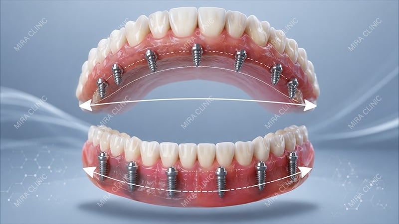 Wider arch support